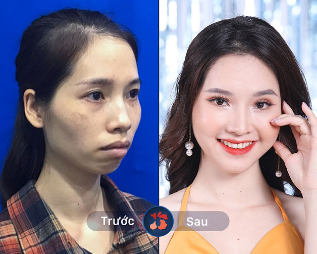 Thi sinh "Hành trình lột xác 2018" Phan Thị May với gương mặt "baby" - trẻ hẳn ra sau cấy mỡ