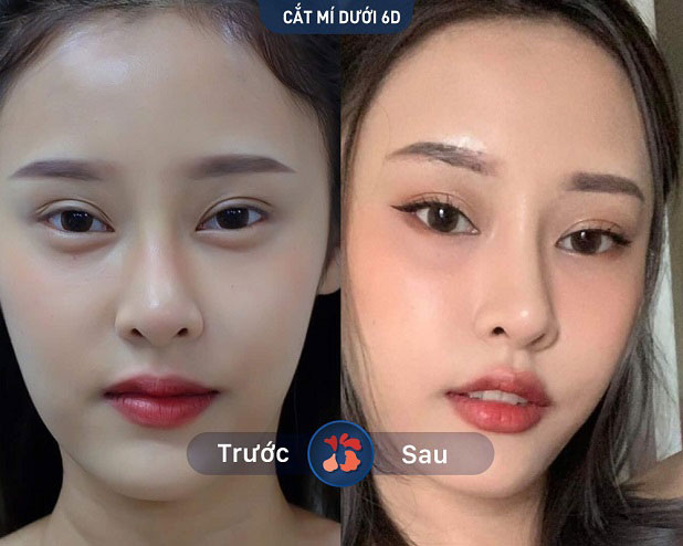 Trước và sau khi khách hàng cắt mí dưới tại Kangnam