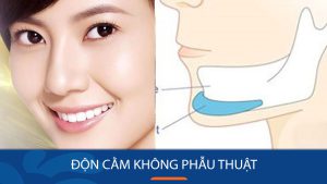 Độn cằm không phẫu thuật: 5 điều cần biết trước khi thực hiện