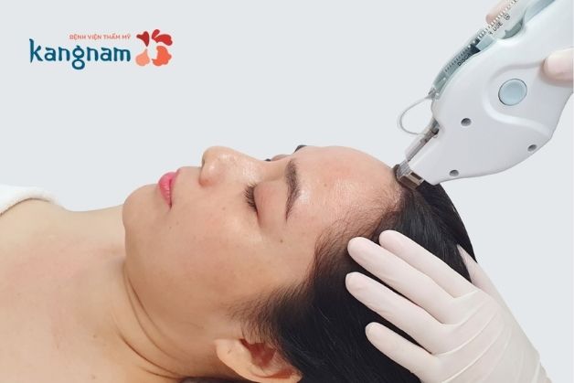 Hình ảnh bác sĩ sử dụng công nghệ Mesotherapy để tác động vào da đầu