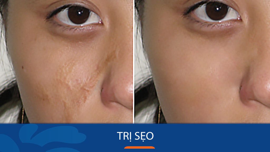 10+ Cách trị sẹo: Nhanh chóng, An toàn, Hiệu quả