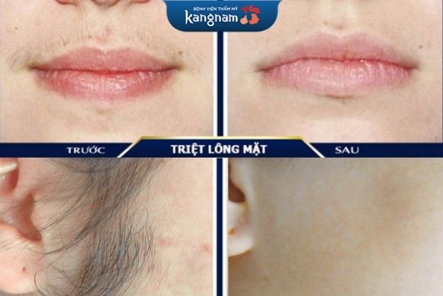 Triệt lông mặt bằng laser tại Kangnam