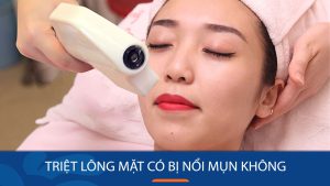Triệt lông mặt có bị nổi mụn không? – Kangnam giải đáp