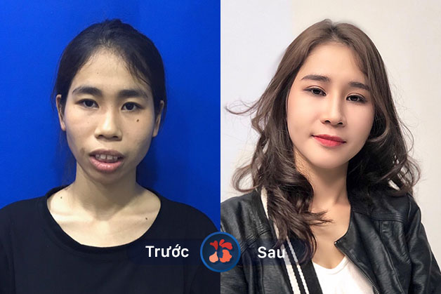Chị Trần Thu Uyên (31 tuổi, Hà Nội): Phẫu thuật hàm hô sau 7 ngày hết sưng, cắt chỉ sớm và hồi phục cơ bản trong 12 ngày.
