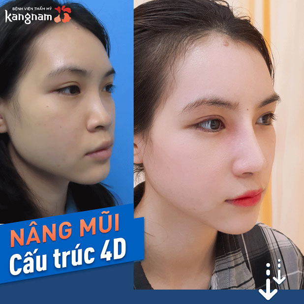 Hình ảnh khách hàng nâng mũi cấu trúc 4D tại Kangnam