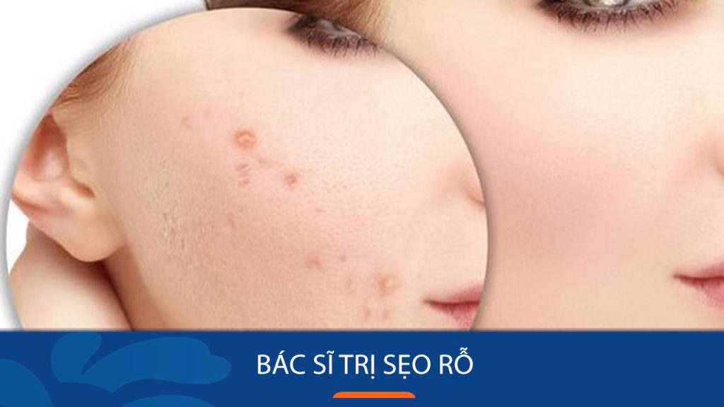 Bác sĩ Da Liễu Chuyên Trị Sẹo Rỗ Uy Tín Tại [Hà Nội]