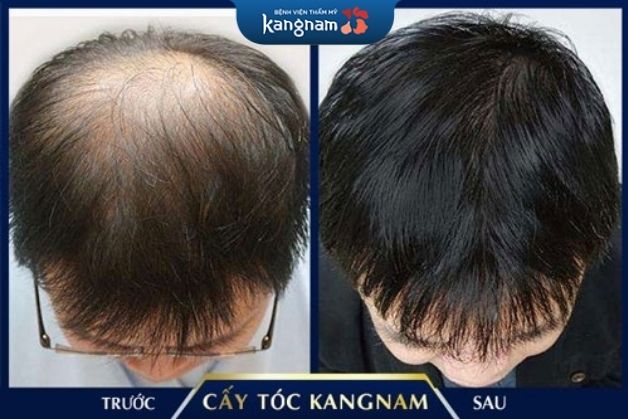 Cấy tóc tự thân cải thiện hói mang đến hiệu quả tự nhiên, lâu dài