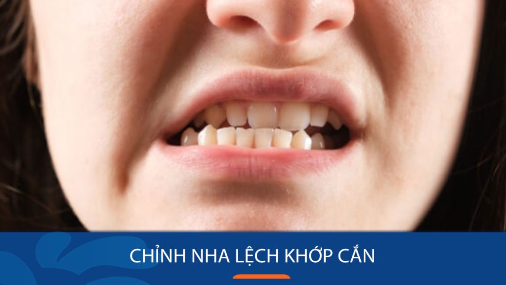 Chỉnh nha lệch khớp cắn: Phương pháp điều trị hiệu quả