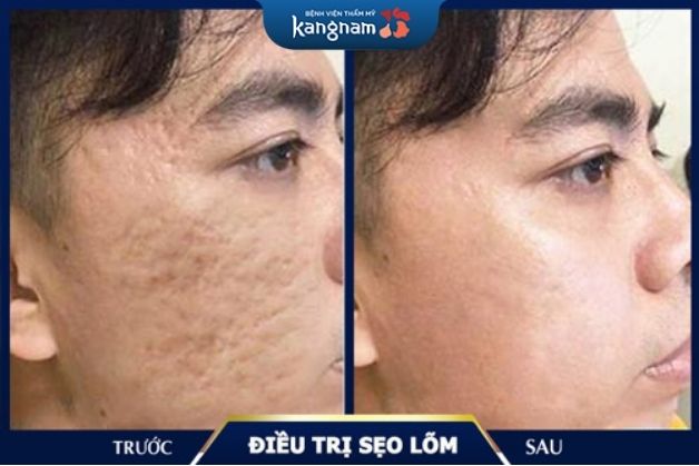 Xóa sạch đến 95% vết sẹo chỉ với 1 liệu trình