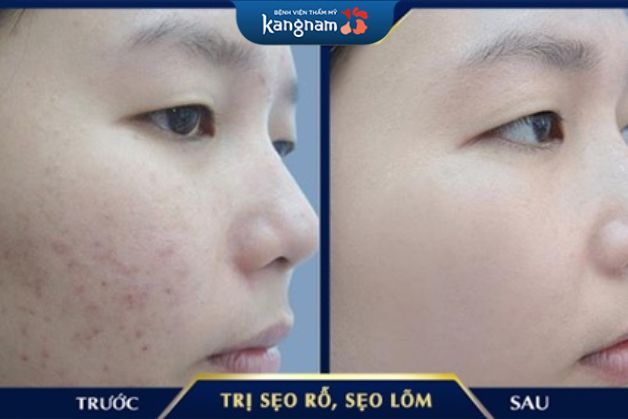 Công nghệ điều trị sẹo rỗ Scar Nano Kangnam