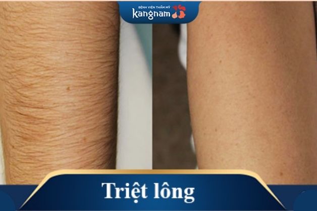 Triệt lông tại Kangnam mang đến hiệu quả tối ưu