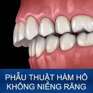 Phẫu thuật hàm hô không niềng răng – Giải pháp làm đẹp tối ưu