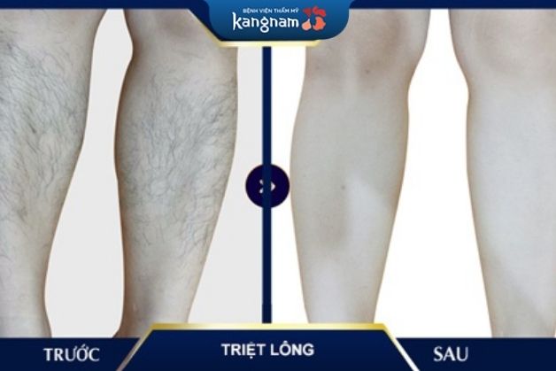 Có nên tẩy lông chân không? Triệt lông an toàn với liệu trình ngắn tại Kangnam