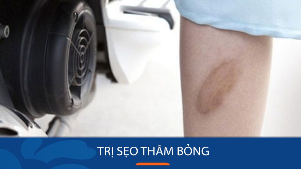 5 Cách Trị Sẹo Thâm Bỏng Hiệu Quả Tại Nhà