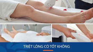 Triệt lông laser có tốt không? Giải đáp mọi thắc mắc