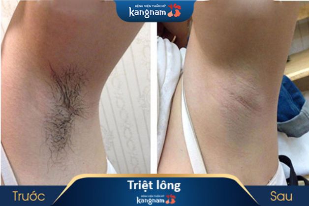 Công nghệ triệt lông an toàn cho da mịn màng tại Kangnam.