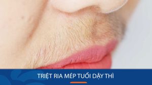 Triệt ria mép tuổi dậy thì: Bí kíp đánh bay vèng vẹt chỉ trong 5 nốt nhạc