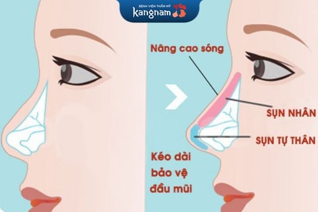 Nâng mũi bọc sụn tai có vĩnh viễn không phụ thuộc vào nhiều yếu tố khác