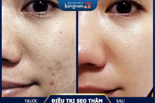 Scar Nano hiệu quả với những vết sẹo thâm lâu ngày