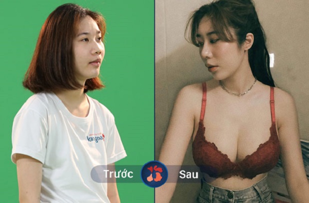 Hình ảnh trước và sau khi khách hàng nâng ngực tại Kangnam