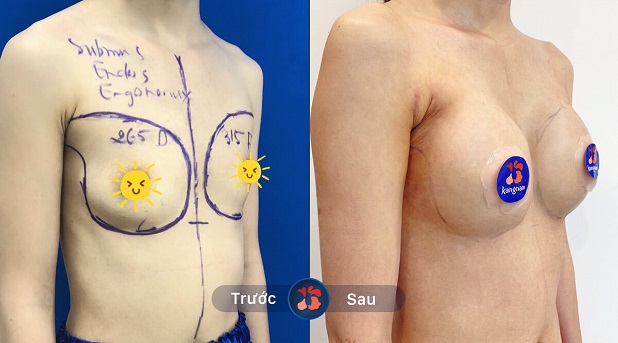 Khách hàng trước và sau khi nâng ngực tại Kangnam