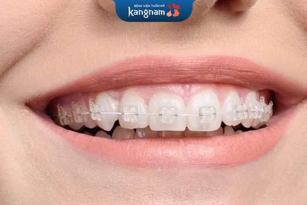 Chi phí niềng răng với mắc cài sứ trong khoảng từ 46.000.000 - 50.000.000 VNĐ