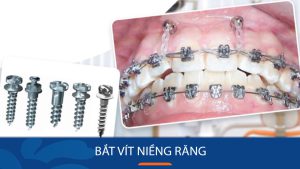 Bắt vít niềng răng có tác dụng gì? Lưu ý cần phải biết