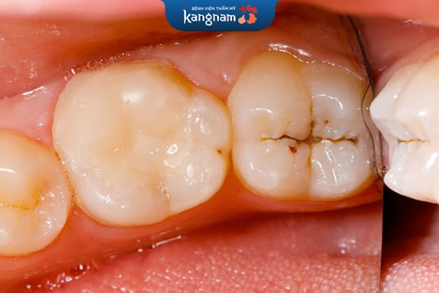 Quá trình oxy hóa của răng có thể gây sâu răng, viêm nướu, ...