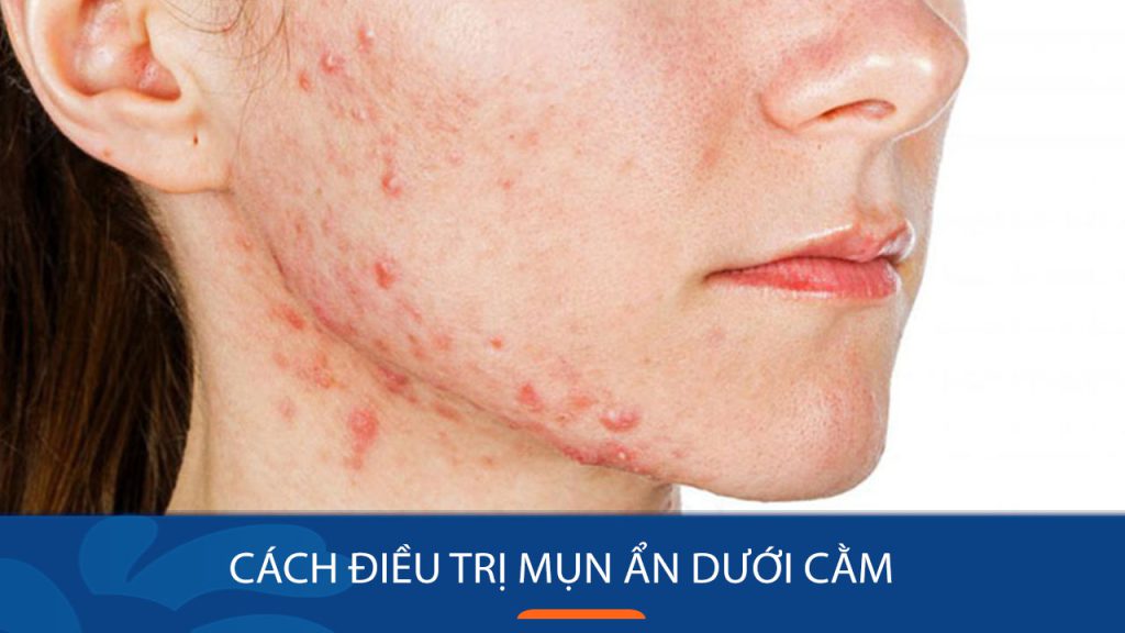 Mụn ẩn dưới cằm – Nỗi ám ảnh và giải pháp “vĩnh biệt” sau 1 tháng