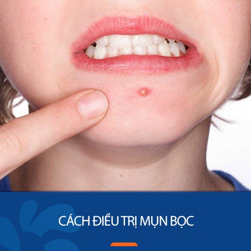 cách trị mụn bọc tại nhà