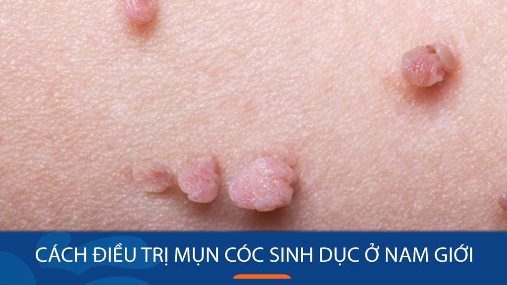 6 Cách Điều Trị Mụn Cóc Sinh Dục Nam Giới Hiệu Quả & An Toàn