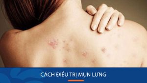 8 Cách điều trị mụn lưng hiệu quả, thoải mái khoe lưng trần