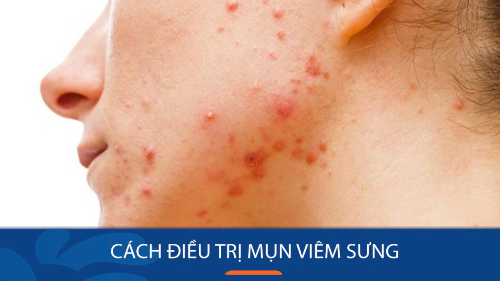 Bí quyết đánh bay mụn viêm sưng – Lấy lại làn da mịn màng không tì vết