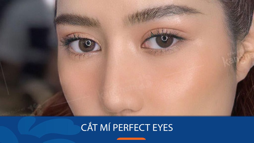 Cắt mí Perfect Eyes: Bí quyết sở hữu đôi mắt to tròn, long lanh