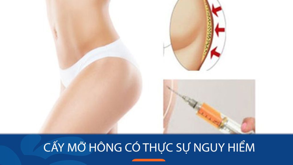 Cấy mỡ hông : Bí quyết cho vòng eo đầy đặn