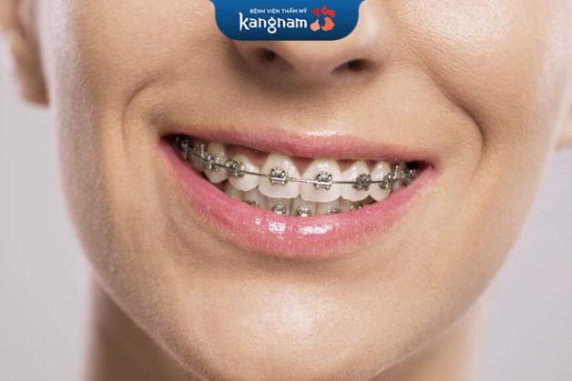 Niềng răng bằng mắc cài kim loại truyền thống là phương pháp đơn giản và phổ biến nhất