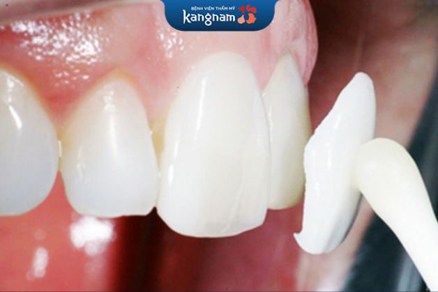 Miếng dán sứ không cần mài răng hoặc mài răng với tỷ lệ thấp,