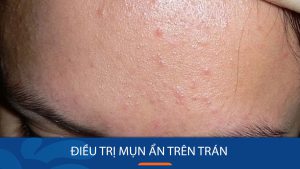 Mụn ẩn trên trán – Nguyên nhân và cách điều trị hiệu quả từ chuyên gia