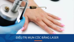 Điều trị mụn cóc bằng laser là gì? Có hiệu quả không