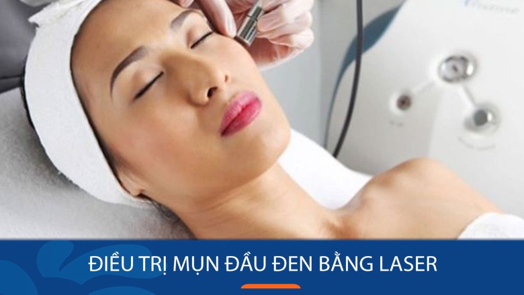Điều trị mụn đầu đen bằng laser: Giải pháp nhanh chóng, hiệu quả và không đau