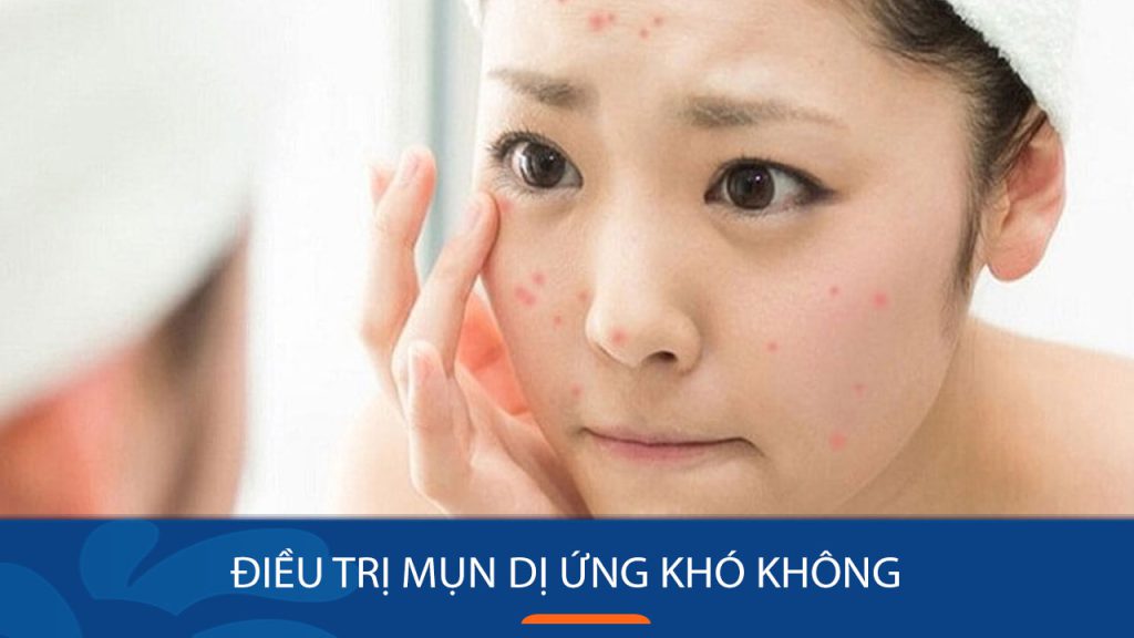 Điều trị mụn dị ứng: Giải pháp dứt điểm cho làn da mịn màng