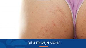 Điều trị mụn mông hiệu quả, ngăn ngừa tình trạng tái lại