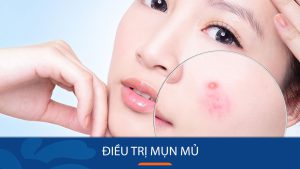 Cách trị mụn mủ dứt điểm tại nhà”, “Bí quyết loại bỏ mụn mủ chỉ trong 7 ngày