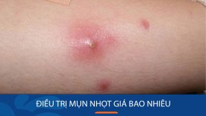 Điều trị mụn nhọt giá bao nhiêu? Chi phí cho từng phương pháp