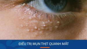 Điều trị mụn thịt quanh mắt: 4 Cách và 7 Sai phạm cần tránh