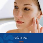 Điều trị nám: 9 Giải pháp hiệu quả và 5 Lưu ý cần biết