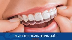 Khay niềng răng trong suốt: 7 Điều quan trọng cần biết