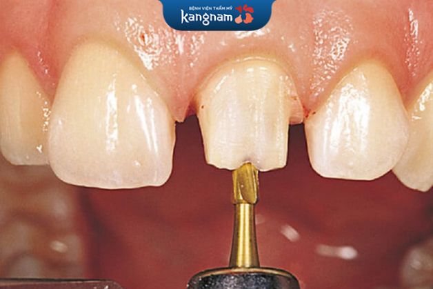 Mài răng không hề ảnh hưởng đến sức khỏe nếu được thực hiện chính xác