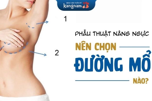 Nâng ngực qua đường nách được nhiều chuyên gia khuyến khích nhất