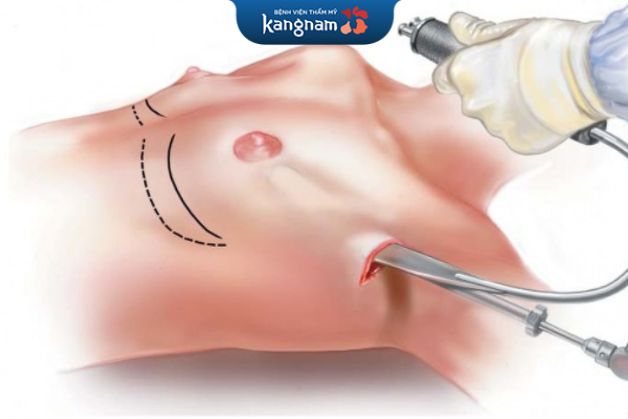 Nâng ngực qua đường nách không làm mất dây thần kinh cảm giác